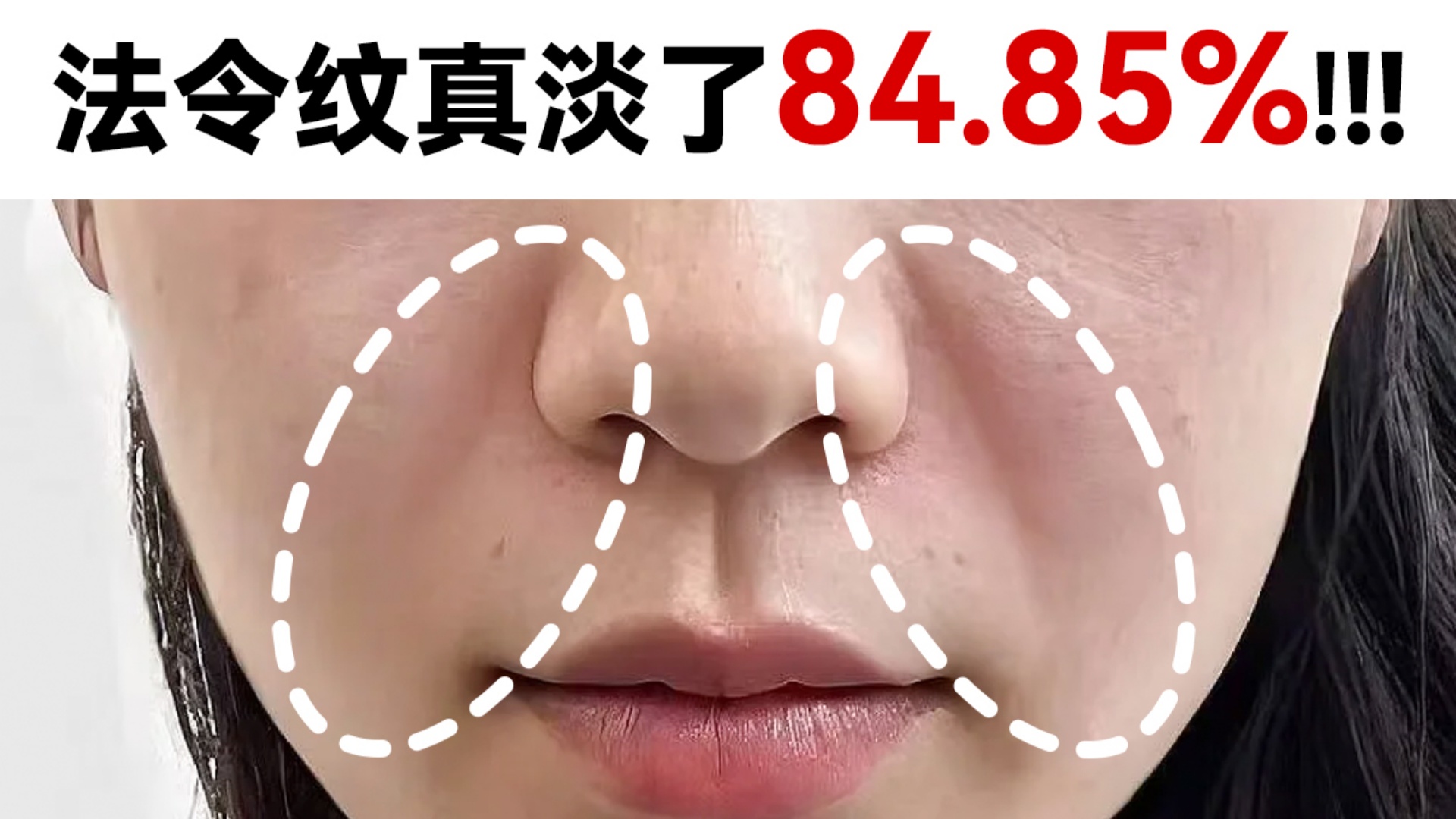 法令纹：建议玛丽仙射频皮肤治疗仪纳入医保